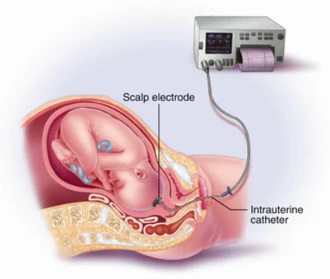 Fetal