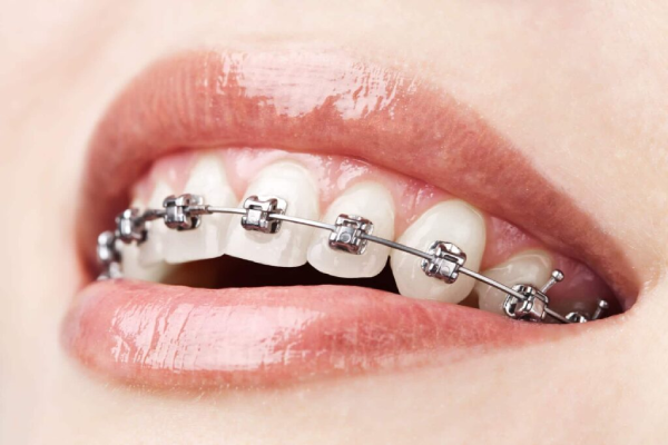 Metal-braces-1024x683