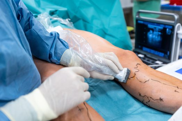 Radiofrequency Ablation