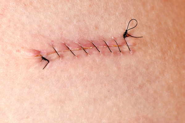 Stiches