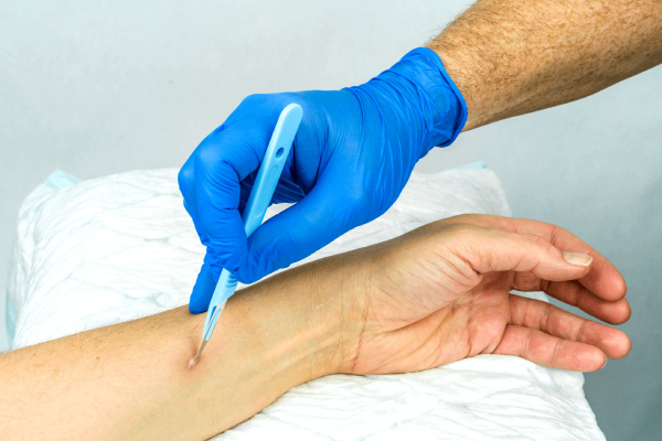 abscesses