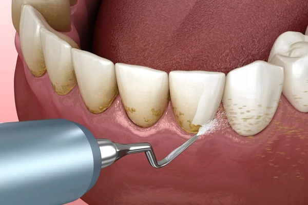 dental_scaling_600x400