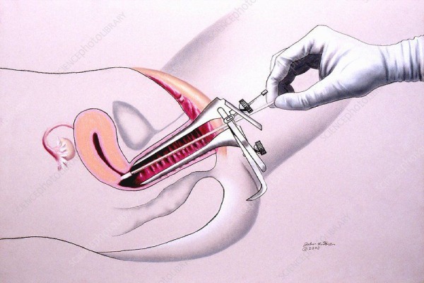 pap smear