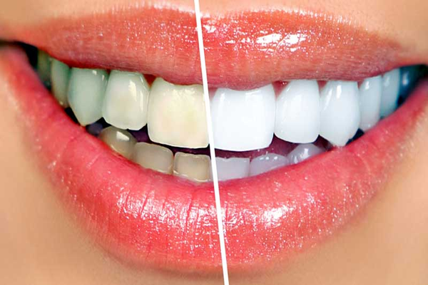 teeth_before_after_600x400