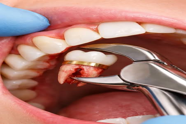 tooth_extraction_600x400