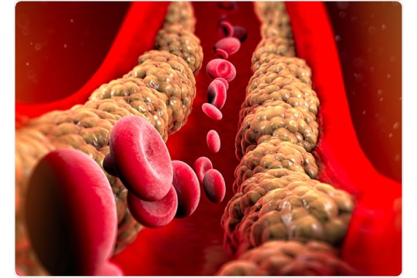 triglycerides