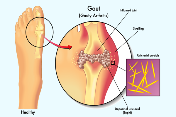 uric_acid_600x400