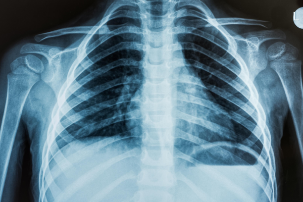 xray chest
